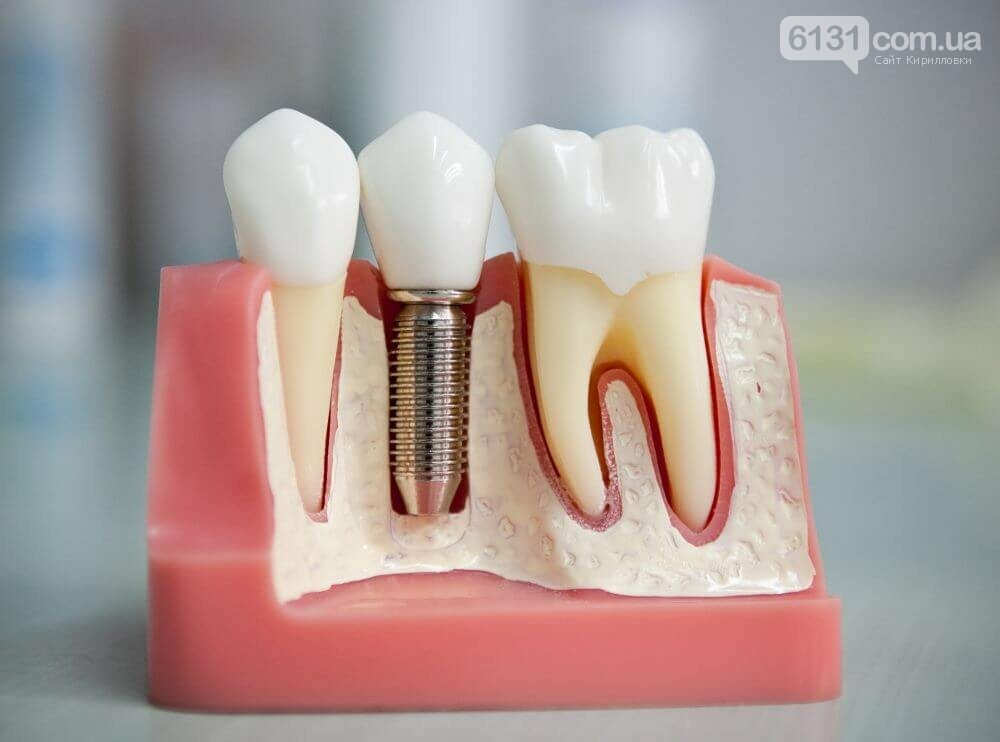 Протезування Зубів: Сучасні Технології та Індивідуальний Підхід, фото-1
